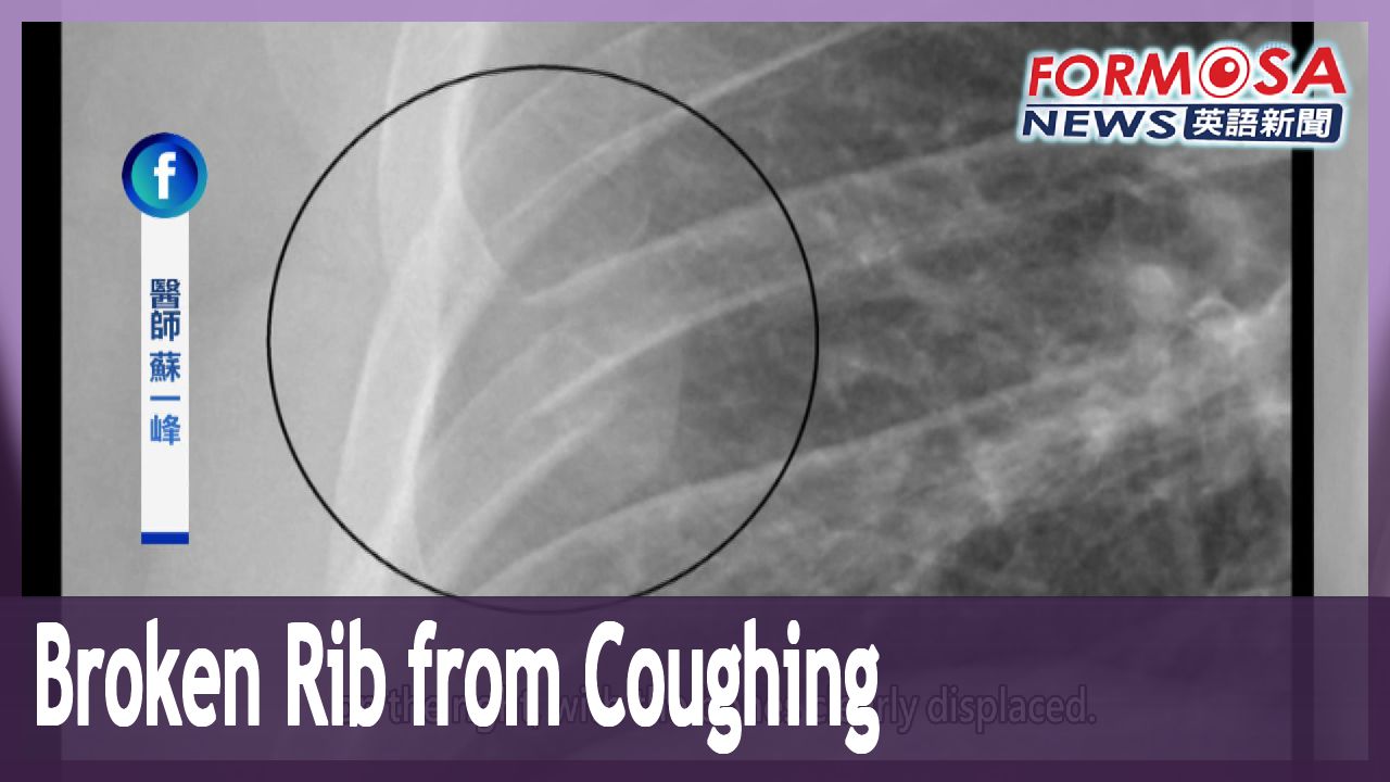 Patient with persistent cough breaks rib in a violent coughing fit