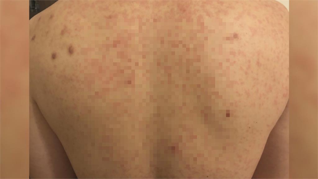 「延遲性過敏」！　50歲男接種莫德納　3天後紅疹