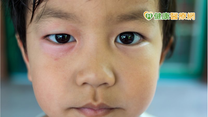 孩子眼皮腫　當心「腎病症侯群」找上門！