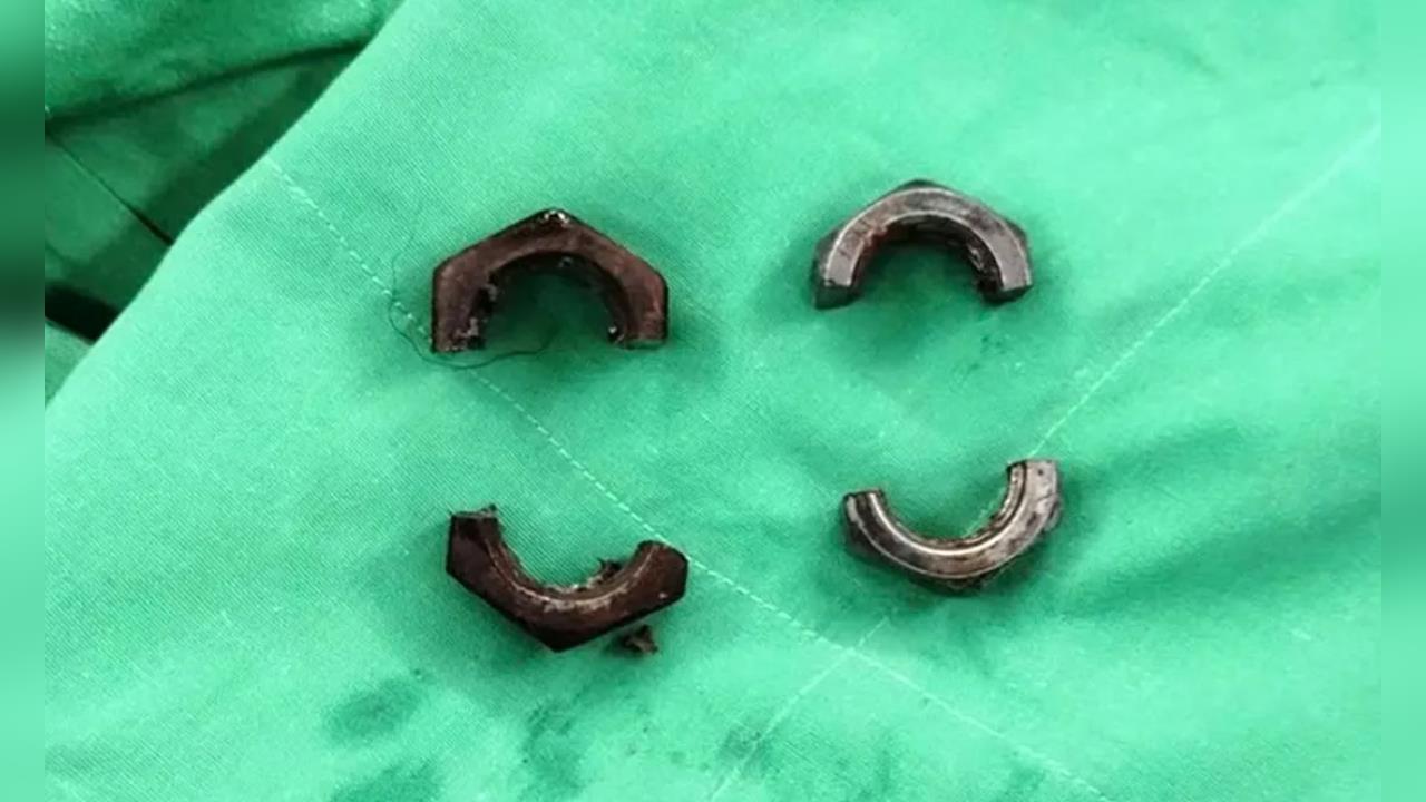 38歲男「螺帽套GG」硬撐1個月才就醫！潰爛變形慘況曝光