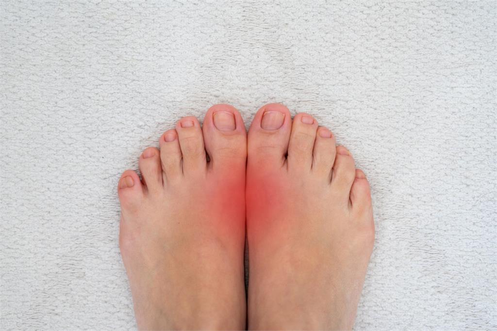 過年大魚大肉！想避免「痛風」掃興 醫示警「8大類人」，飲食「5方法」不發作