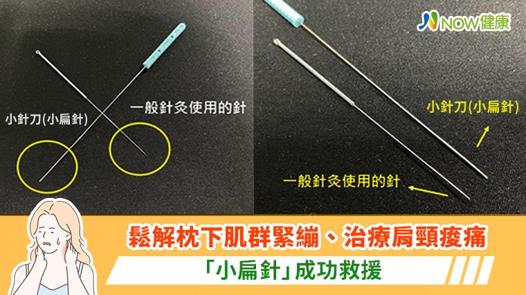 鬆解枕下肌群緊繃、治療肩頸痠痛 「小扁針」成功救援