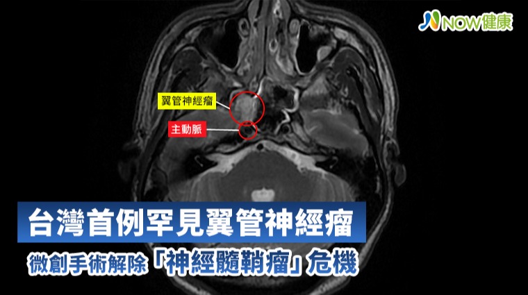 鼻過敏導致鼻水「共共流」 檢查竟發現罕見翼管神經瘤