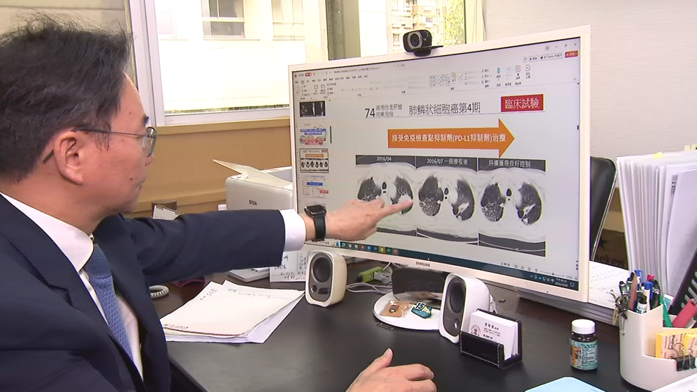 6成肺癌發現已晚期　「一療法」證實可延長存活期