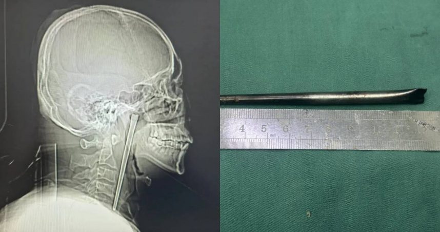 酒後誤吞12cm金屬筷「忍痛8年才就醫取出」 46歲男嘆:當初怕開刀