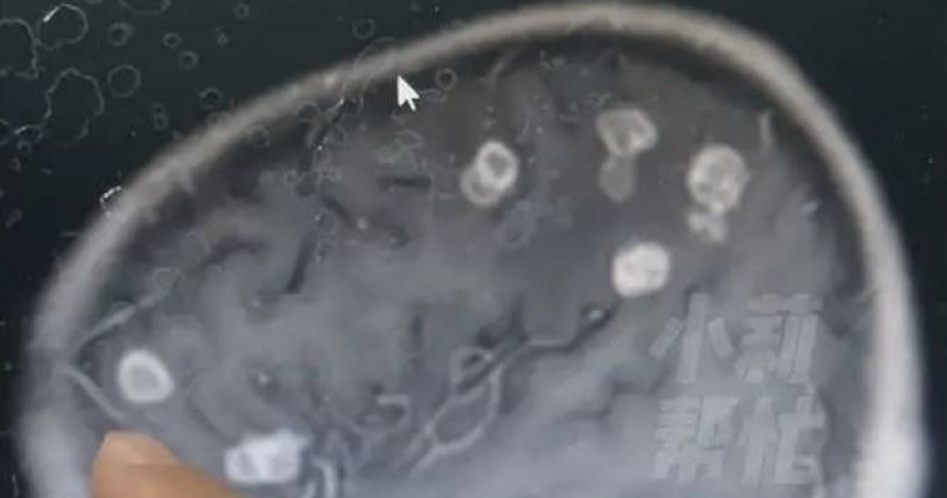 大掃除完6歲妹狂燒17天！檢查驚見「腦被啃出20個洞」　醫揭恐怖元凶