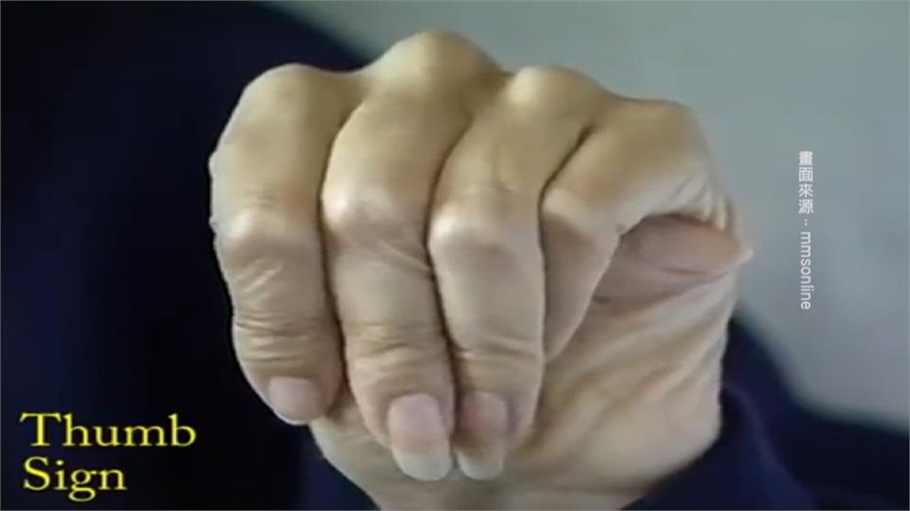 拇指向內握拳超出小指  主動脈剝離高風險群