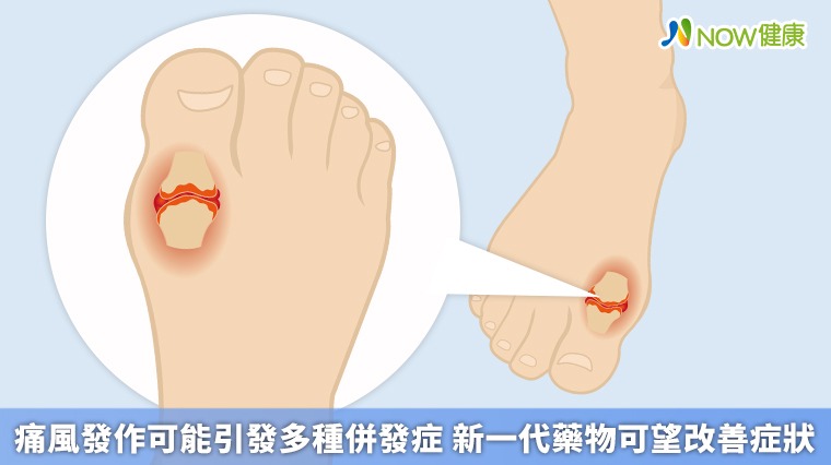 痛風發作可能引發多種併發症 新一代藥物可望改善症狀