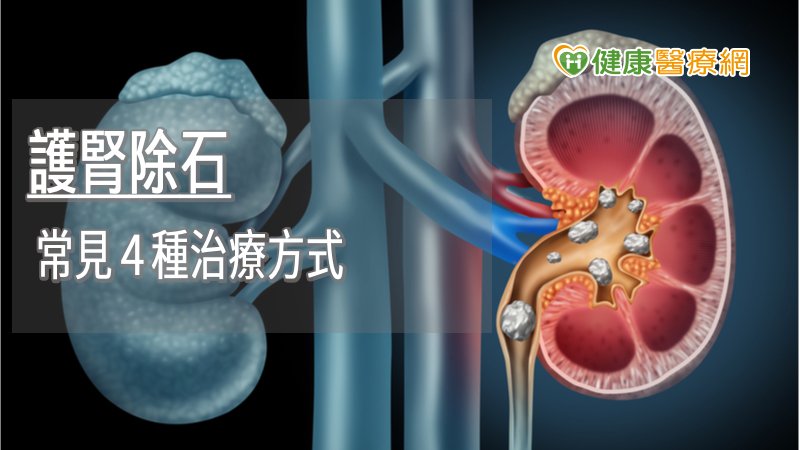 治療複雜性腎結石　常見手術優缺點一張圖看懂