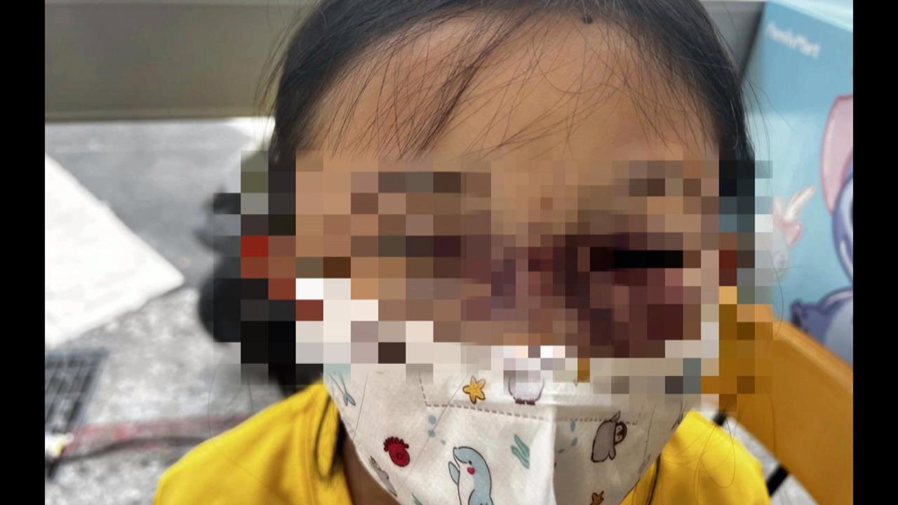 2童校園互撞女童臉「鼻青臉腫」　校方第一時間未送醫　家長怒了