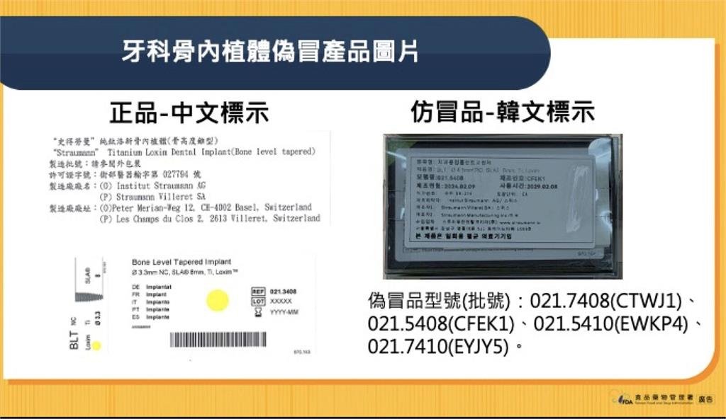 高價植牙有「假」！食藥署查獲仿冒骨內植體   韓文標示4批號曝光