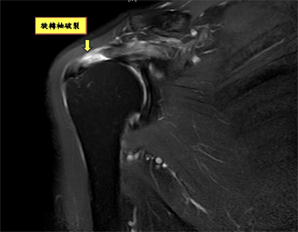 肩膀抬不起來只是五十肩? 復健再多都無用!旋轉袖破裂恐開刀