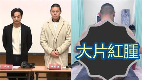 閩南狼決裂八炯消失1個月！突公開「背部大片紅腫」驚悚照：最痛不是被敵人打