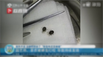 壁蝨叮咬也致命！　中國蜱蟲引發「新布尼亞病毒」感染