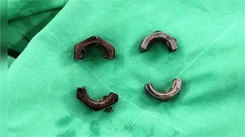 38歲男「螺帽套GG」硬撐1個月才就醫！潰爛變形慘況曝光
