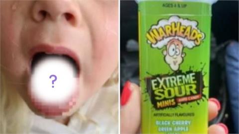 4歲女童吃「酸酸糖」舌頭灼傷破大洞！圖片超嚇人　醫：酸性比檸檬更強