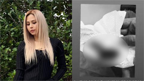 女星疑病倒曬「拔罐染血紙巾照」！昔窮到剩1000元嘆：慶祝我還有生命