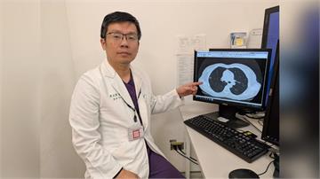 肺癌初期「幾乎無症狀」！LDCT早期發現！醫：「這事」肺癌風險評估最重要