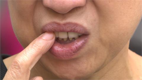 「陶瓷牙套」才剛裝就問題百出　患者保固期回診控遭醫師請離