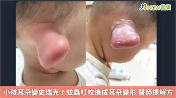 小孩耳朵變史瑞克！蚊蟲叮咬造成耳朵變形　醫師提解方
