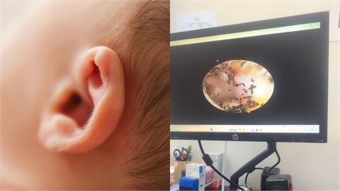 女童耳朵痛送醫後「挖出大量跳蚤」駭人畫面曝光！媽媽親揭感染原因