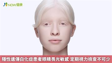 隱性遺傳白化症患者眼睛畏光敏感　定期視力檢查不可少