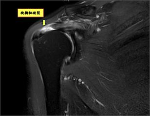 肩膀抬不起來只是五十肩? 復健再多都無用!旋轉袖破裂恐開刀