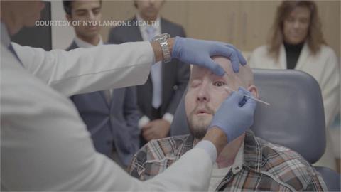 全球首例！美國工人觸電左眼受創　全眼移植手術可望重見光明