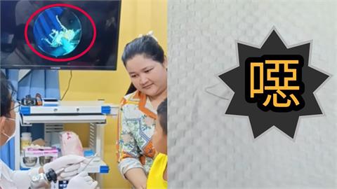 有影/柬埔寨男童喊耳痛 醫檢查驚見「活蟑螂瘋狂蠕動」駭人畫面流出