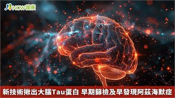 新技術揪出大腦Tau蛋白 早期篩檢及早發現阿茲海默症
