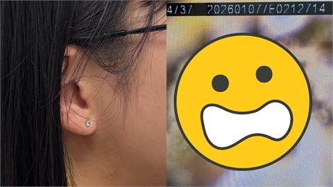 密集恐懼慎入！年輕女耳朵竟「長白香菇」畫面曝光　醫揭「1習慣」惹禍：長黴了