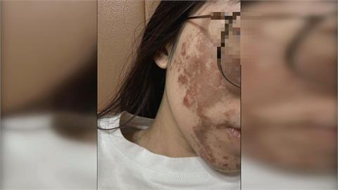 換膚變毀容！美容師疑誤拿高濃度果酸　女臉部大面積灼傷
