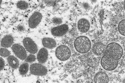 快新聞／美國首度度發現兒童猴痘病例　2幼童疑家庭傳播感染