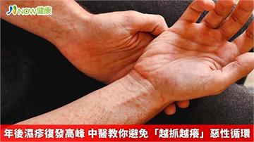 年後濕疹復發高峰 中醫教你避免「越抓越癢」惡性循環