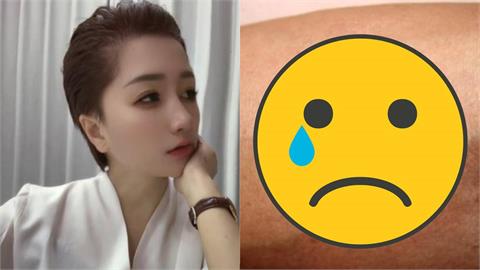 39歲網紅遭蟲咬病逝！疾管署急警「死亡率飆60％」台灣已56例確診