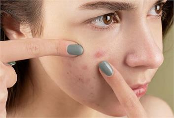 顛覆印象！30至49歲冒「青春痘」最慘  元凶並非臉洗不乾淨