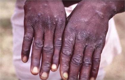 快新聞／猴痘疫情蔓延15國　比利時開第一槍：患者需強制隔離21天