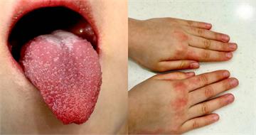 4歲妹高燒4天張口驚見「草莓舌」 醫示警快送急診:恐釀心臟後遺症