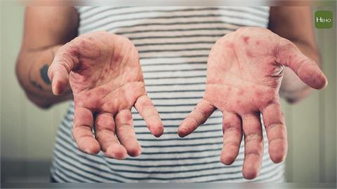 高雄小學爆腸病毒群聚！隱瞞病情害14生感染　明結業式改線上