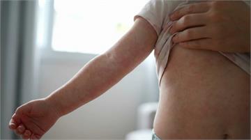 玫瑰疹只有退燒才長？與病毒疹差異在哪？會復發嗎？醫教7招判斷