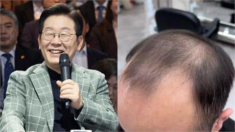 南韓總統拋新政策：「禿頭藥」納健保！兩派網友戰翻天：在開玩笑？