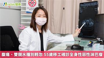 腹痛、雙腿水腫別輕忽 55歲移工確診全身性惡性淋巴瘤