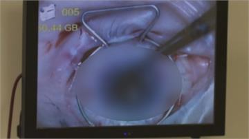 4D技術培養人工角膜 搶救眼疾患者惡視力