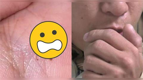 男喉嚨卡3天「不是感冒」咳出活蟲！女友「PO特寫照急問」全場超抖