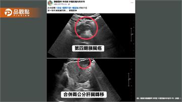 血糖失控竟是癌王警訊！50歲男確診胰臟癌四期已轉移肝臟