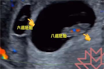 意外驚喜！ 8週孕婦產檢 發現多一個6週胚胎