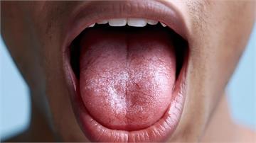 張嘴吐舌看健康！從「舌苔」窺探五臟密碼，6種常見舌象一次看懂