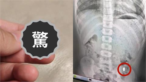 11歲男童稱練舌力誤吞「10克金豆」 媽氣炸:不准在外面上廁所!