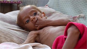 葉門內戰4年 統計8.5萬名孩童饑病死亡