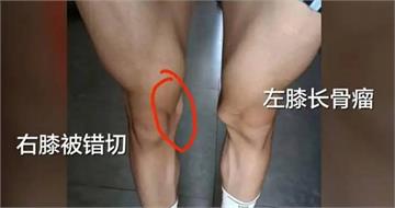 17歲體育生左膝長骨瘤！醫生竟「錯切右膝」　母親發聲：不接受和解